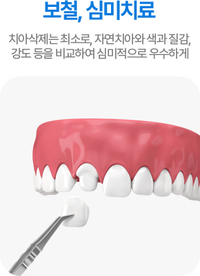 보철, 심미치료