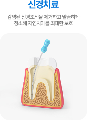 신경치료